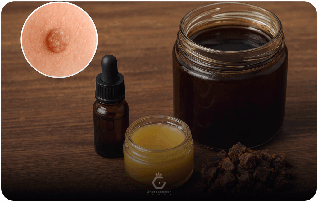 نحوه استفاده از بره موم برای درمان زگیل تناسلی