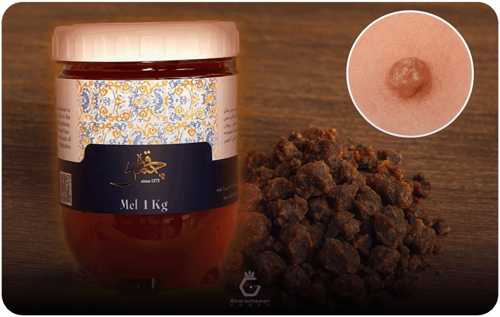 فواید بره موم در درمان زگیل تناسلی