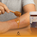 درمان اگزما با عسل